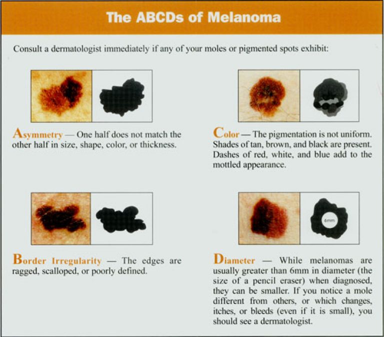 melanoma-abcd