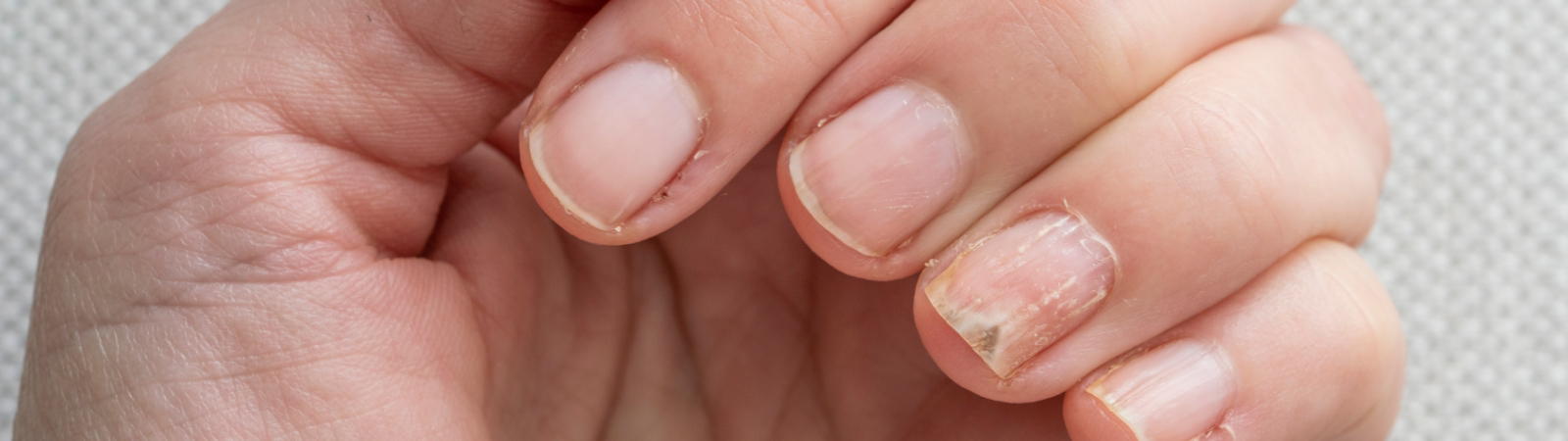 Close-up of a hand with damaged fingernails showing signs of peeling, discoloration, and brittleness. The background is a soft, textured surface.