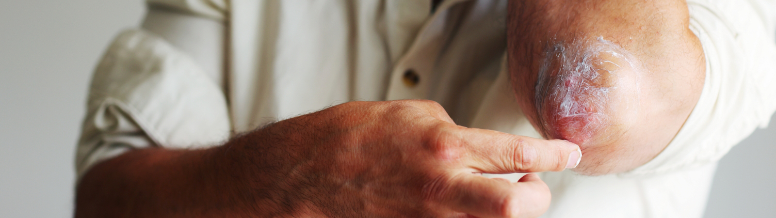 A person applying topical cream to a patch of dry, irritated skin on their elbow.