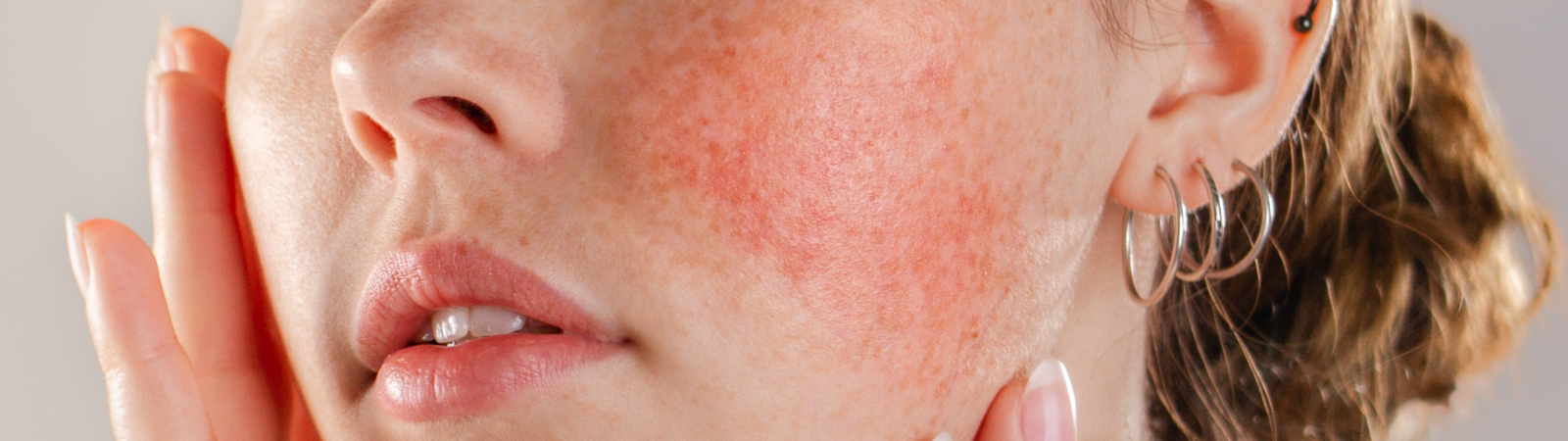 A close-up of a person's face showing red, irritated skin on the cheek. The person is gently touching the affected area with their hand.