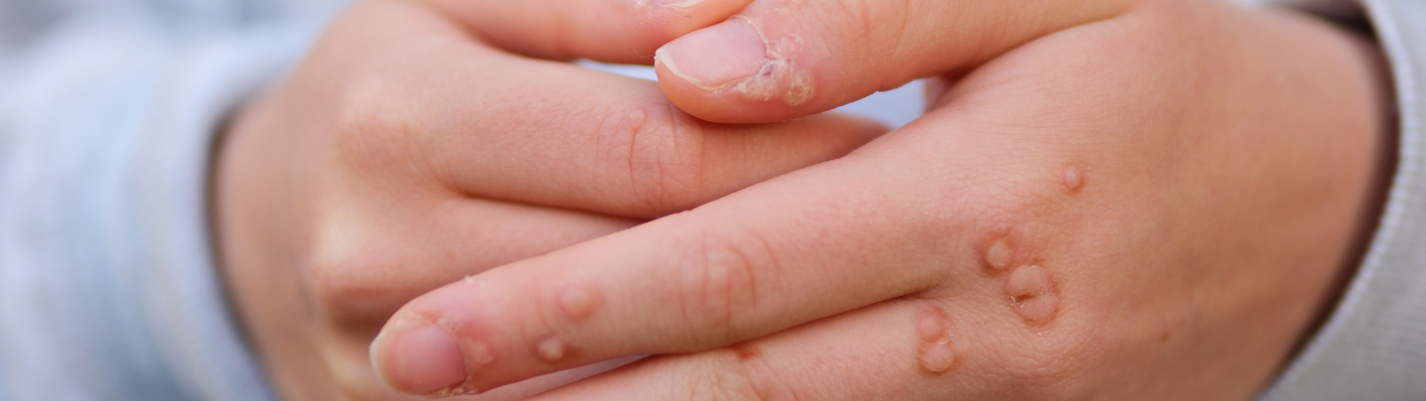 Close-up of hands with several small warts on the fingers and nails.
